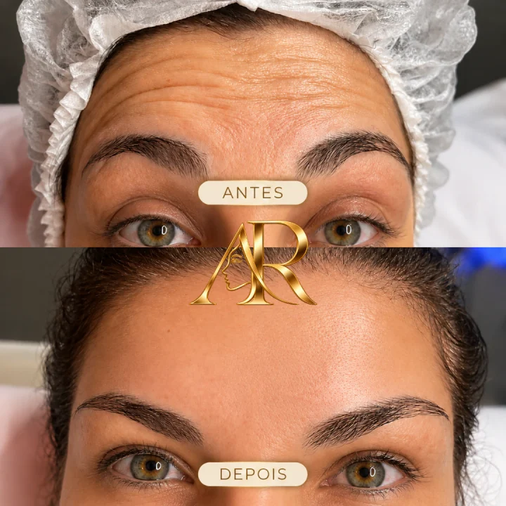 Resultado real 5 de 5: antes e depois de procedimento realizado pela Dra. Andrieli Rossa